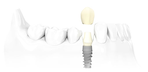 crown over implant