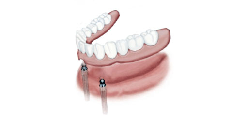 teeth implants for full mouth