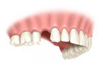 missing gap for dental implant
