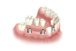 tooth implant crowns