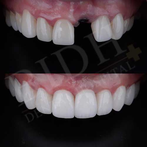 case dental implants bidh