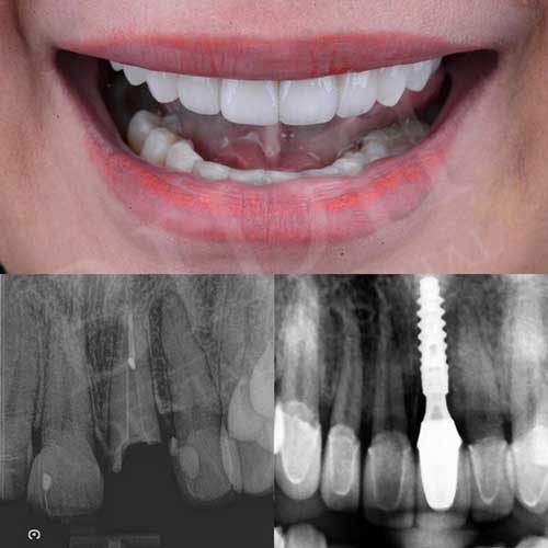 case dental implants